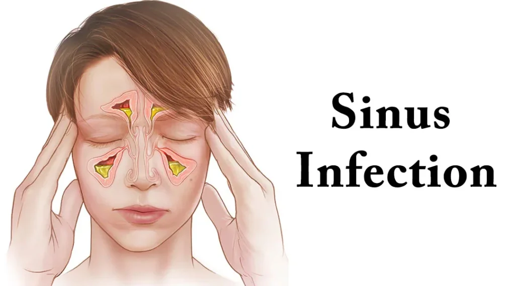 Sinus-Infection - Dr. Manasi Mehra Sinus Infection
