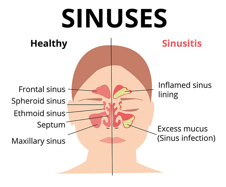 causes of sinus - Dr. Manasi Mehra how-to-know-sinus-problem
